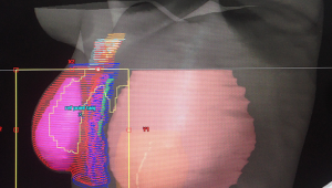 RADYOTERAPİ KORKULACAK BİR YÖNTEM DEĞİLDİR