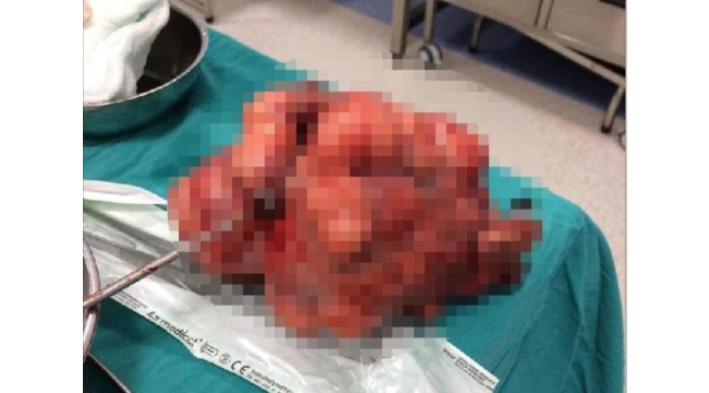 Karnından 2 kiloluk tümör çıkarıldı